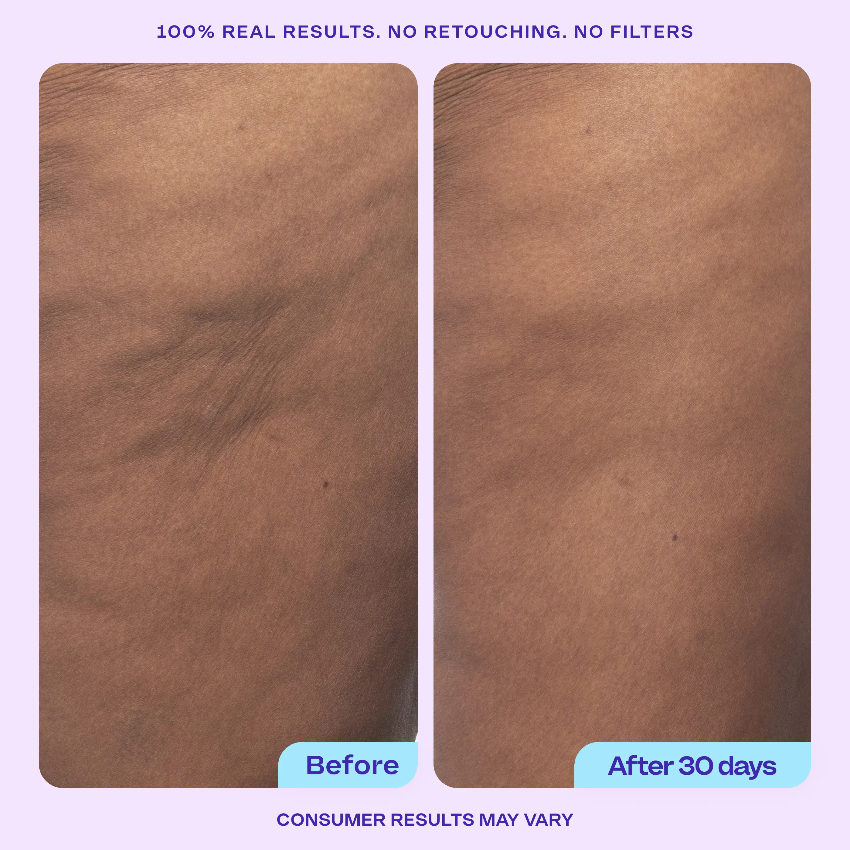 Firming Butt & Thigh Cream – Clinically Tested Body Butter for Stretch Marks, Dimpled Texture & Loose Skin